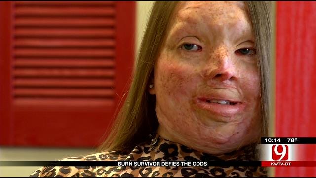 Oklahoma Teen Beats The Odds 15 Years After Severe Burn
