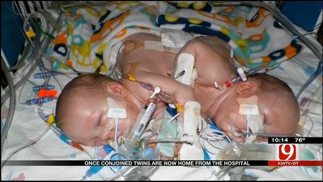 Now Separated, Conjoined Twins Go Home, Require Constant Care