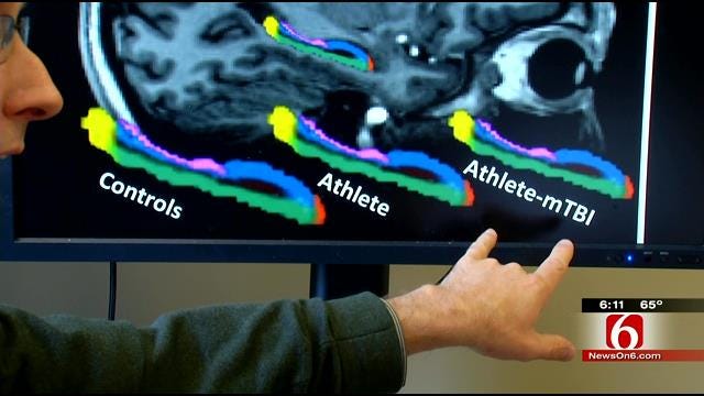 TU Concussion Study Shows Memory Section Of Brain Smaller In Football Players