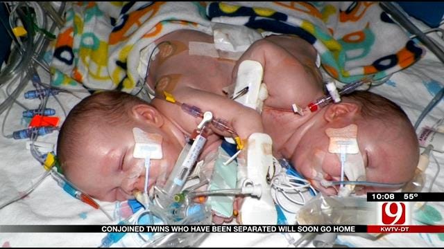 Once Conjoined Twins Still Defying The Odds