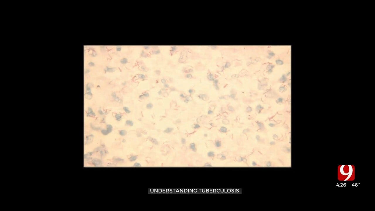 Medical Minute: Understanding Tuberculosis