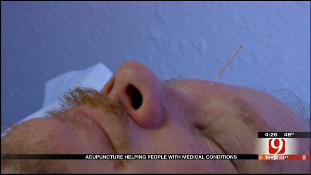 Medical Minute: Restorative Powers Of Acupuncture