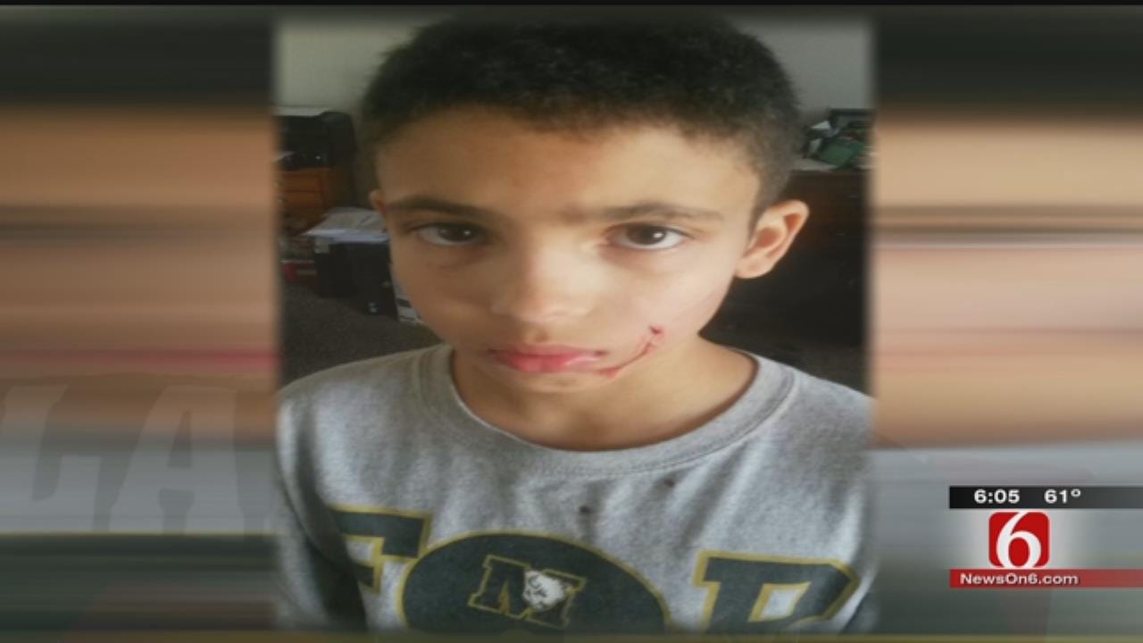 Police Search For Tips On Dog Who Attacked 10-Year-Old Boy