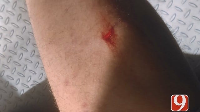 Metro Man Says Dogs Attacked Him