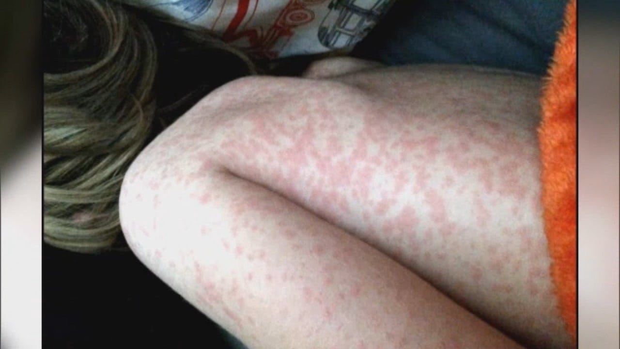 Growing Measles Outbreak In Washington Spreading Fear Among Parents