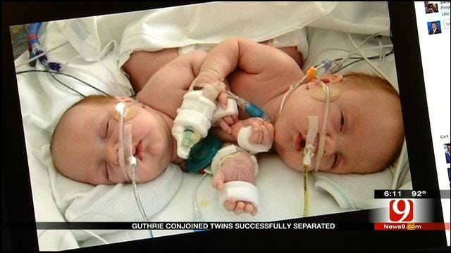 Oklahoma Family Celebrates Successful Separation Of Conjoined Twins