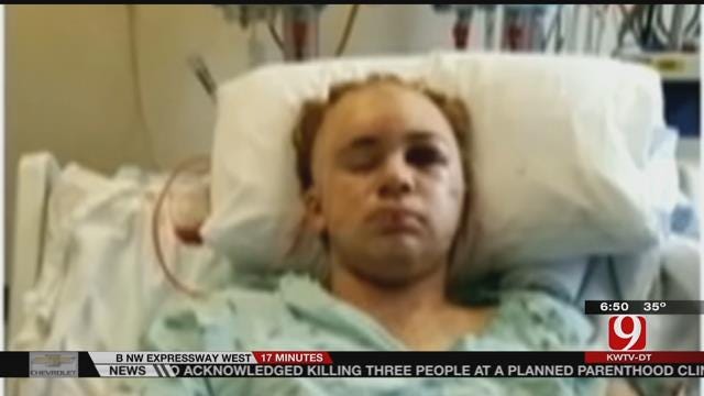 Teen Injured In 'Duct Tape Challenge' Warns Others
