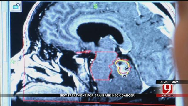 Medical Minute: New Treatment For Brain, Neck Cancer