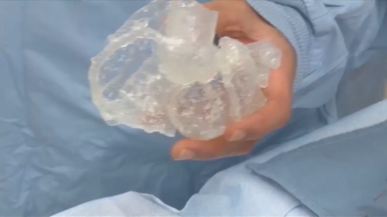 Doctors Use 3D Printed Heart To Practice Procedure