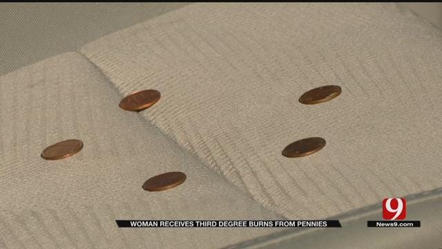 Woman Receives Third Degree Burns From Pennies