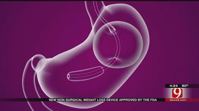Medical Minute: Belly Balloon