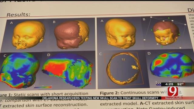 Medical Minute: Skull Scan For Babies