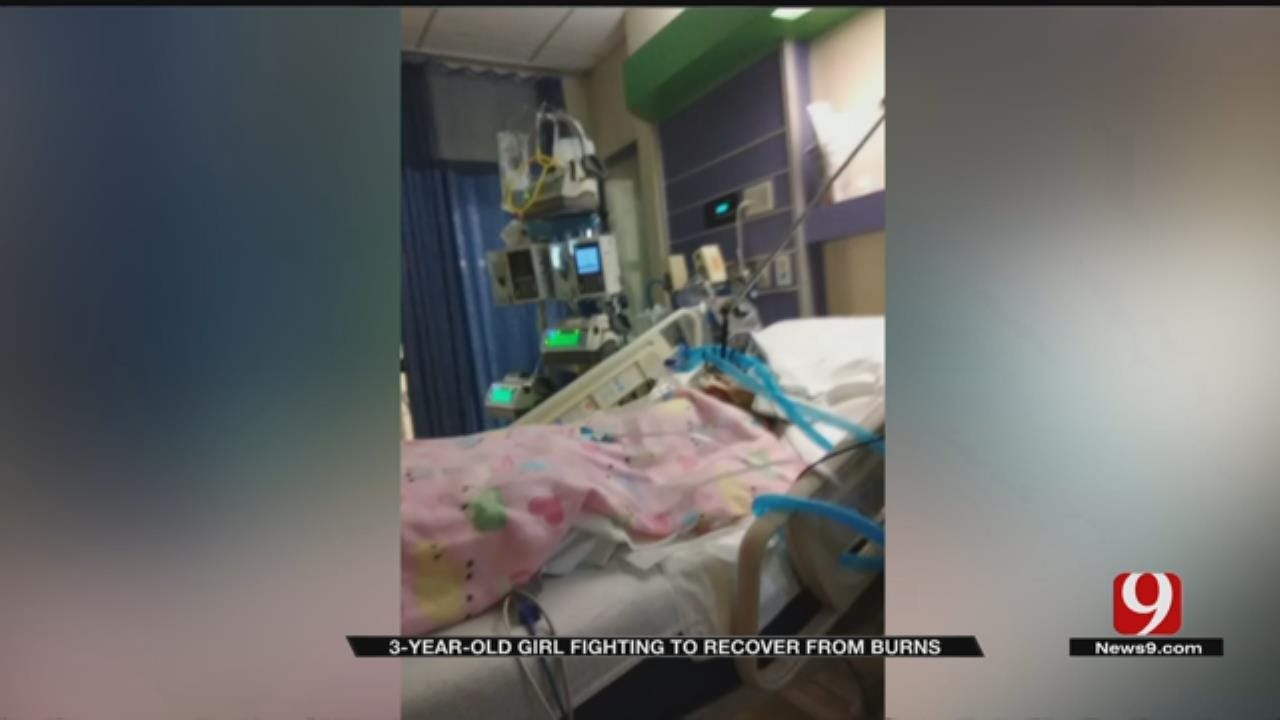 3-Year-Old Girl Fighting To Recover From Burns