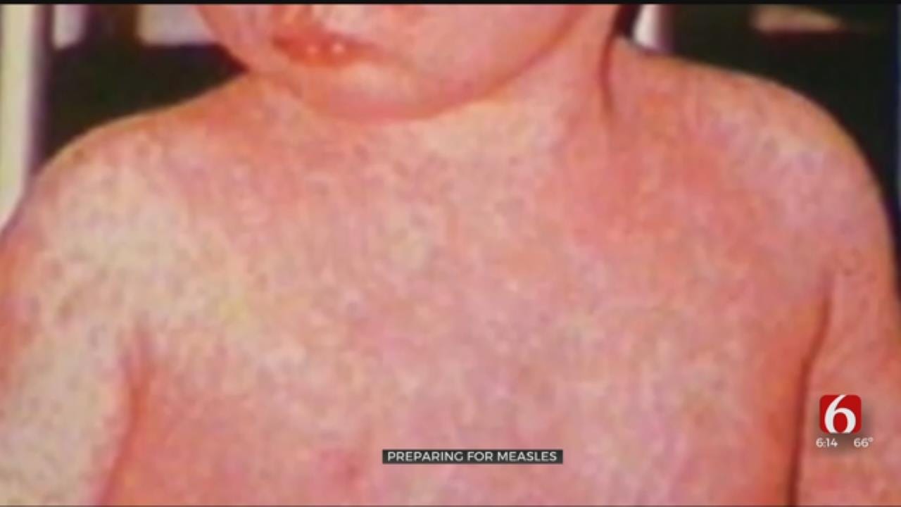 Tulsa County Health Dept. Focusing On Possibility Of Measles