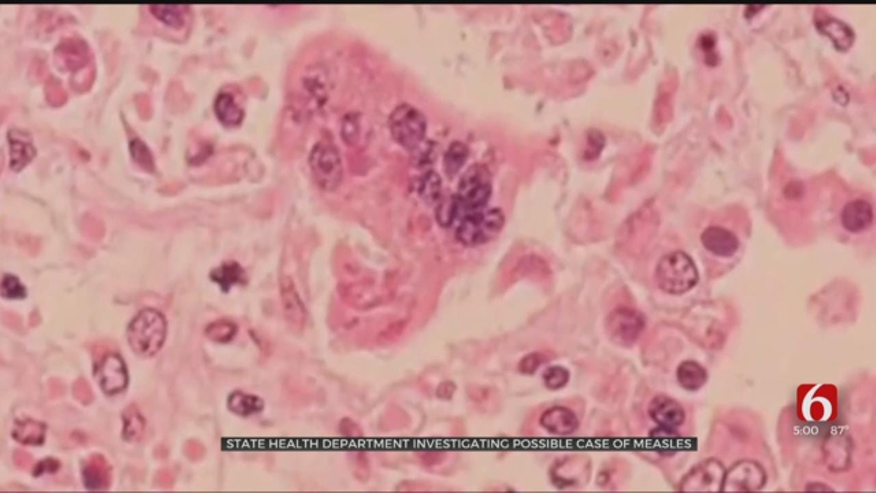 Tulsa Health Department Leaders Using Measles Case To Inform Citizens