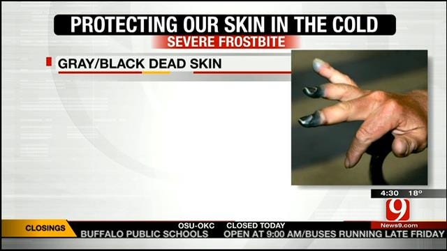 Medical Minute: Protecting Our Skin In The Cold