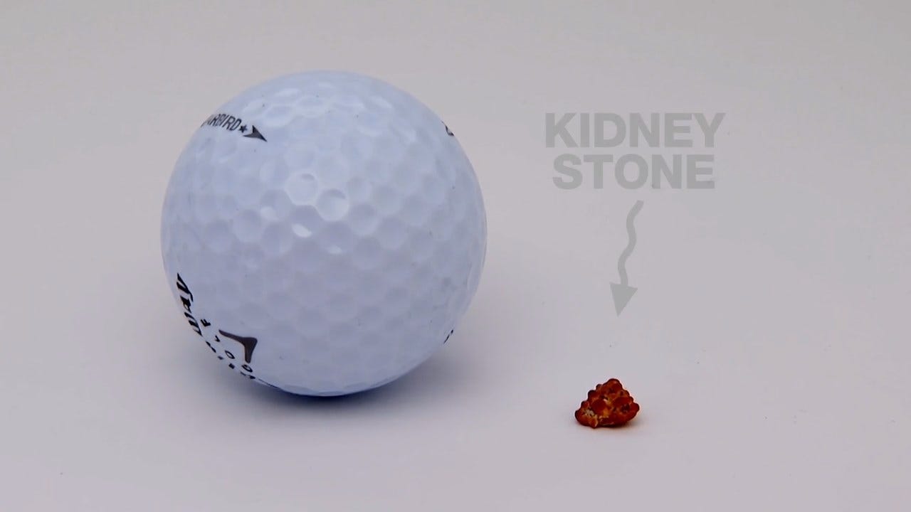 Urologic Specialists Kidney Stone Oct