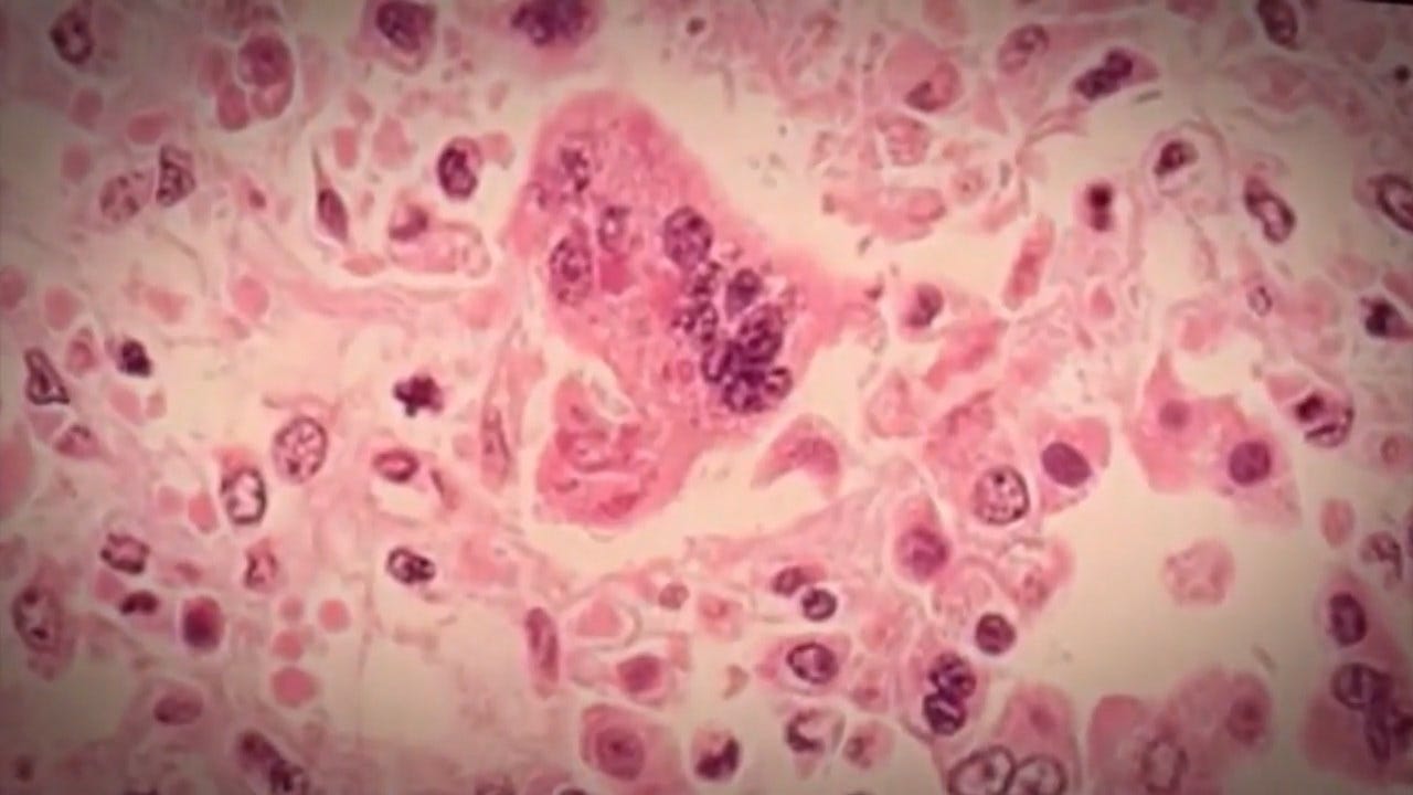 Measles Outbreak: Nearly 300 Students Quarantined At 2 California Universities