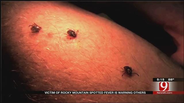 Oklahoma Victim Of Rocky Mountain Spotted Fever Is Warning Others