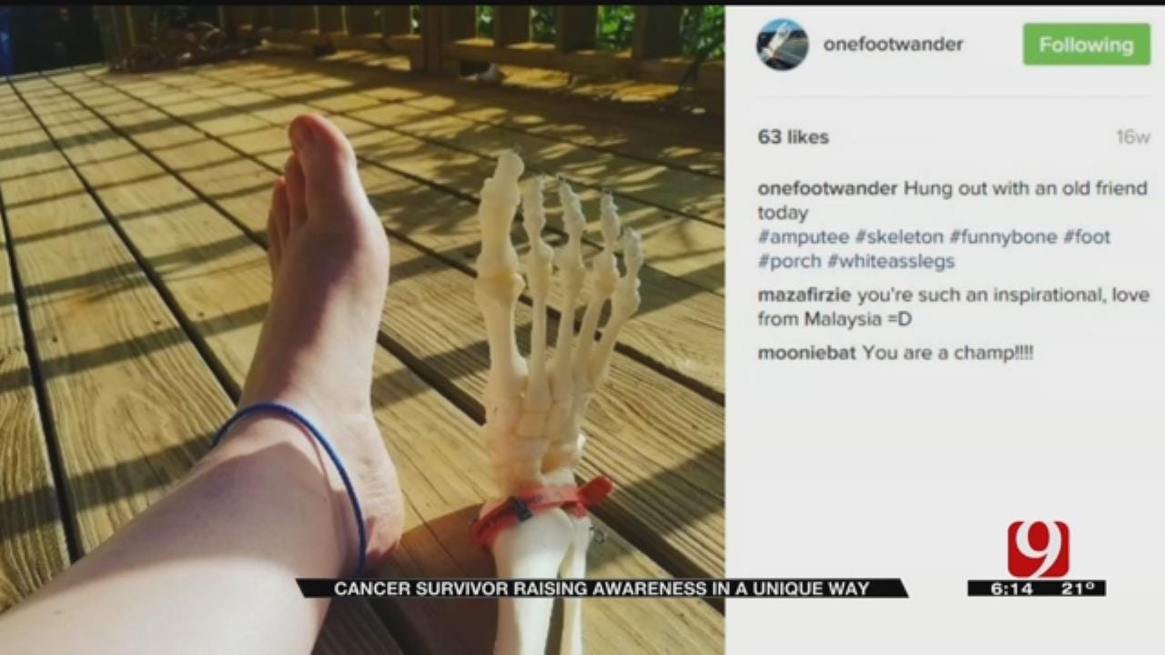 Oklahoma Cancer Survivor Uses Amputated Foot To Inspire Others
