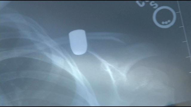 Okmulgee Girl Struck By Stray Bullet On July 4 Also Suffered Broken Rib